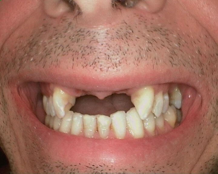 Smile before cosmetic reconstruction - Clinique dentaire Morin-Houle in Hull